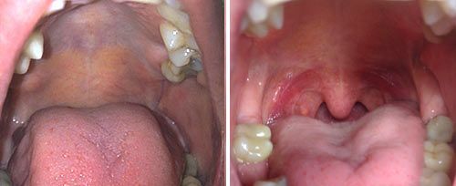 NightLase treatment result example 2